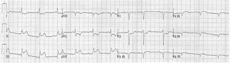 Anterior Myocardial Infarction Litfl Ecg Library Hot Sex Picture