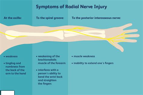 Ulnar Nerve Injury Cause Symptom Treatment Exercise