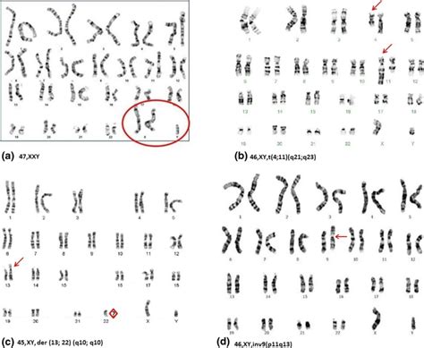 Examples Of Karyotype Anomalies A Klinefelter Syndrome47 XXY Adopted