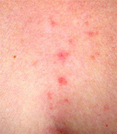 Skin Rashes That Itch Lines Lasigene