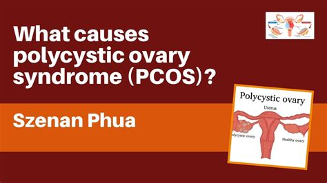 What Causes Polycystic Ovary Syndrome Pcos Youtube