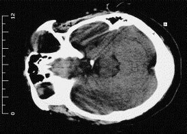 Lipedematous alopecia: An unusual sequela of discoid lupus ...