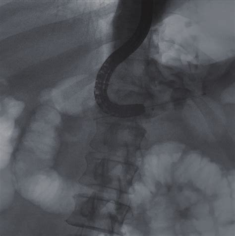Ercp Reveals The Large Pancreaticoduodenal Fistula With Contrast