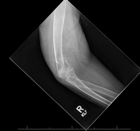 Distal Humerus Fracture Radiology Case
