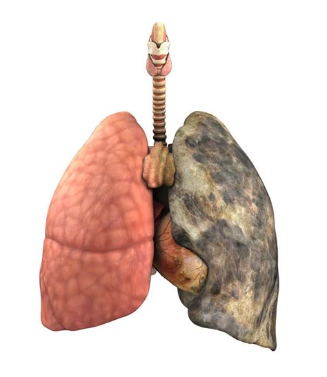 Both lung cancer and chronic obstructive pulmonary disease (copd) affect your lungs. What Is COPD? An Overview of COPD MyHeart