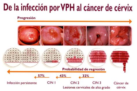 Infecci N Por Virus De Papiloma Humano Y C Ncer De C Rvix Joaqu N Olmedo