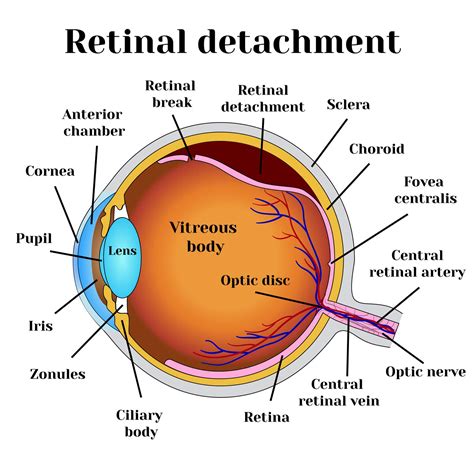 What Is Retinal Detachment And How To Treat It