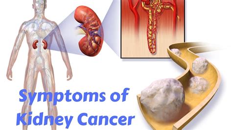 The Most Common Symptoms Of Kidney Cancer Youtube