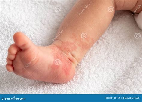 Hemangioma Red Birthmark On The Leg Of Newborn Baby Stock Image Image