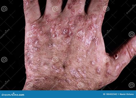 Psoriasis Eczema On The Hand Isolated On Black Background Stock Photo