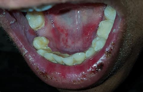 Derm Dx Painful Lesions In The Mouth Clinical Advisor