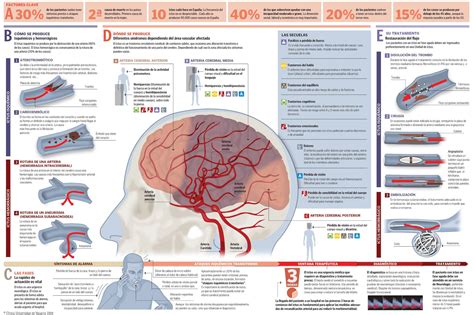 Accidente Vascular Sintomas