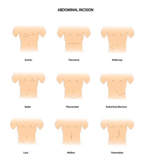 Abdomen Incision Illustrations Royalty Free Vector Graphics And Clip Art