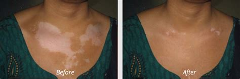 Best Vitiligo Treatment In India Leucodermawhite Patches Specialist