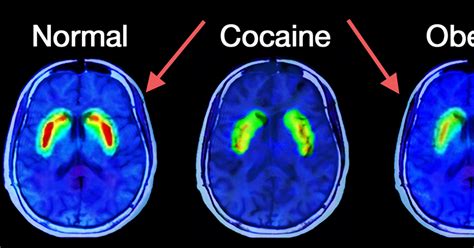 What Happens In The Brain Of An Addict Attn