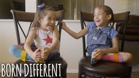 The Conjoined Twins Who Were Separated Born Different Youtube
