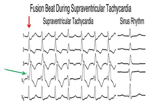 Dr Smiths Ecg Blog Fusion Beat During Supraventricular Tachycardia