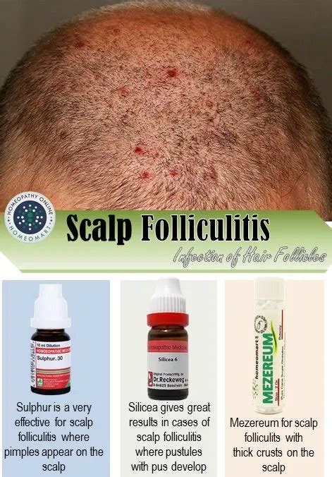 Top Homeopathy Medicines For Scalp Folliculitis And Other Scalp Infections