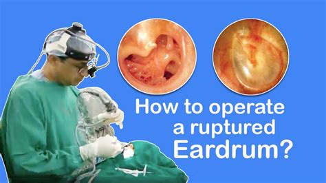Cartilage Tympanoplasty How To Operate A Ruptured Eardrum Youtube