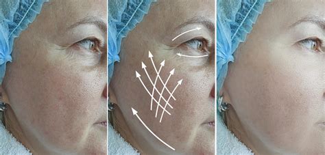Woman Wrinkles Removal Effect Lift Plastic Skin After Beautician