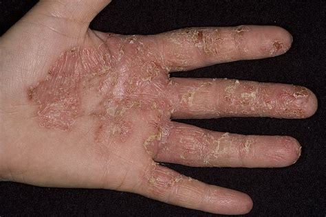 Weeping Eczema On Hands Pictures 41 Photos And Images