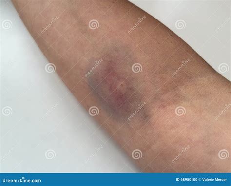 Ruptured Vein Bruise Stock Photo Image Of Elbow Blood 68950100