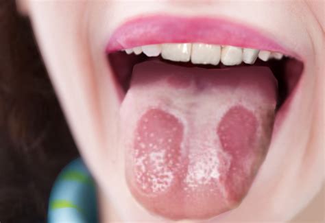 Geographic Tongue Article