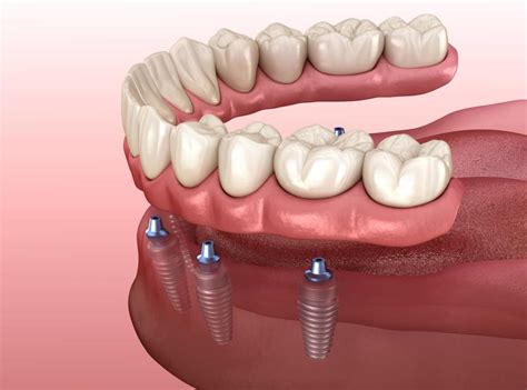 What To Expect During The Denture Implant Healing Stages