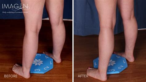 Body Areas Ankles Liposuction By Imagen Body Sculpting
