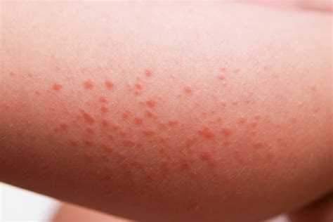 Celiac Disease Rash Dermatitis Herpetiformis Explained Good For You Gluten Free