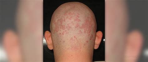 Seborrheic Dermatitis Symptoms Skin And Hair Problems Articles Body