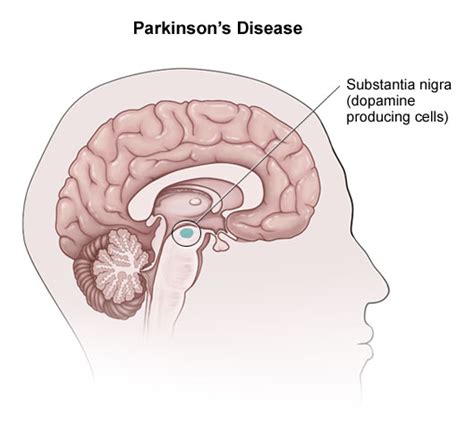 Parkinsons Disease Healthcare Online