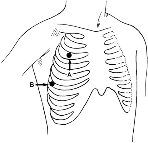 20 Chest Tube Placement Perform Clinical Gate