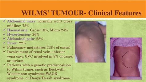 Wilms Tumour Pediatric Surgery