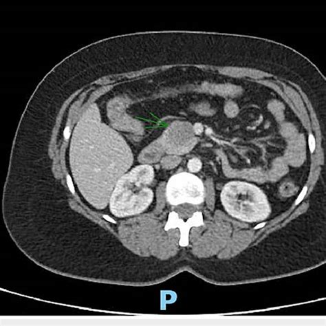 Ct Scan Of The Abdomen With Intravenous Contrast An Axial Section Image