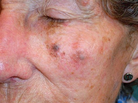 What Skin Cancer Looks Like When It Starts Skin Cancer Symptoms Types And Warning Signs This