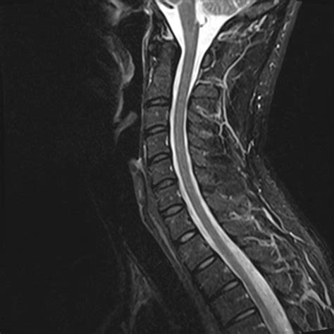 Normal Cervical Spine Mri Radiology Case