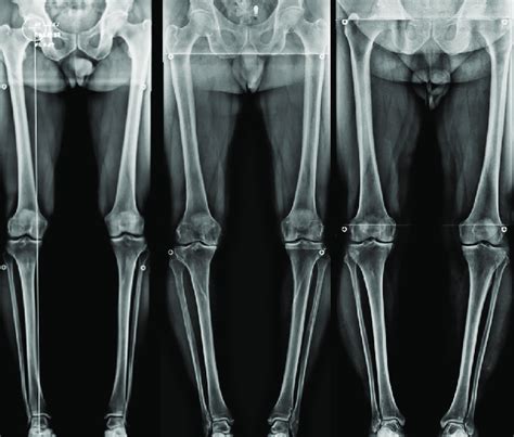 X Ray Leg