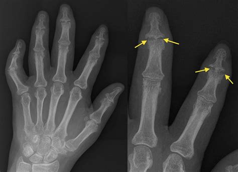 Psoriatic Arthritis Dip Erosions Radiology At St Vincents