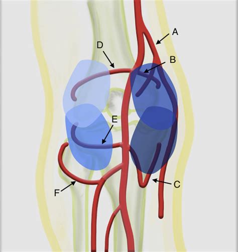Genicular Artery Embolization For The Treatment Of Knee Pain Secondary