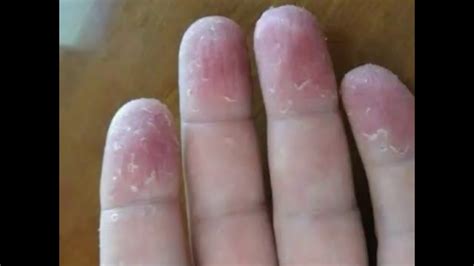 Como Tratar La Dermatitis En Los Dedos