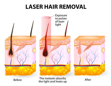 Laser Hair Removal Faqs Everything You Want To Know Laserall