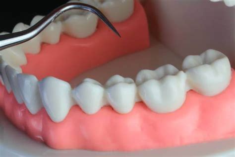 Pericoronitis Treatment Symptoms And Treatment The Houston Dentists