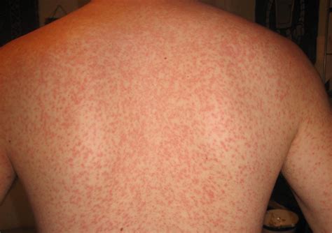 Viral Rash Types Symptoms And Treatment In Adults And Babies
