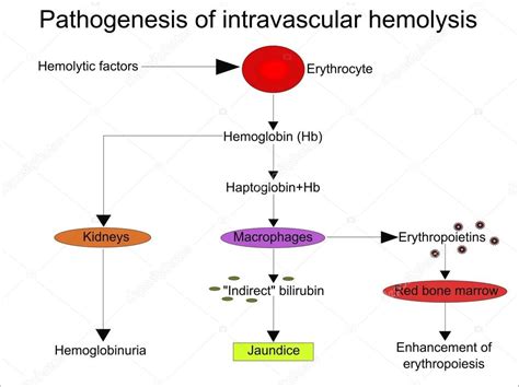 Extravascular hemolysis does not cause hemoglobinemia and hemoglobinuria but usually causes hemolytic icterus (hyperbilirubinemia associated with bilirubinuria). Patogénesis de la hemólisis intravascular Imagen Vectorial ...