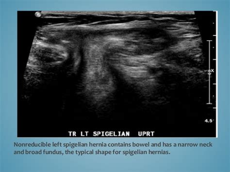 Spigelian Hernia Medical Ultrasound Ultrasound Medical