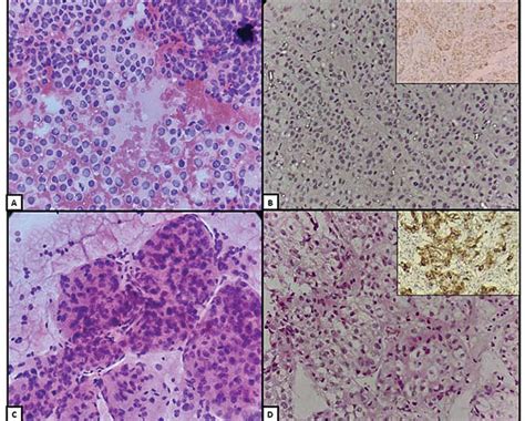 Fna Features Of Adrenal Cortical Carcinoma Showing Tumor Cells With