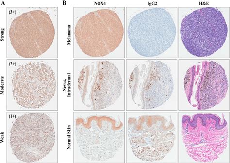 Immunohistochemical Ihc Staining Of Melanoma Tissues Demonstrating