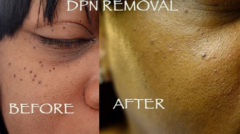 Dpn Removal Dermatosis Papulosa Nigra Youtube