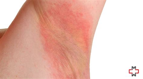 Armpit Rash Causes Treatment And Prevention